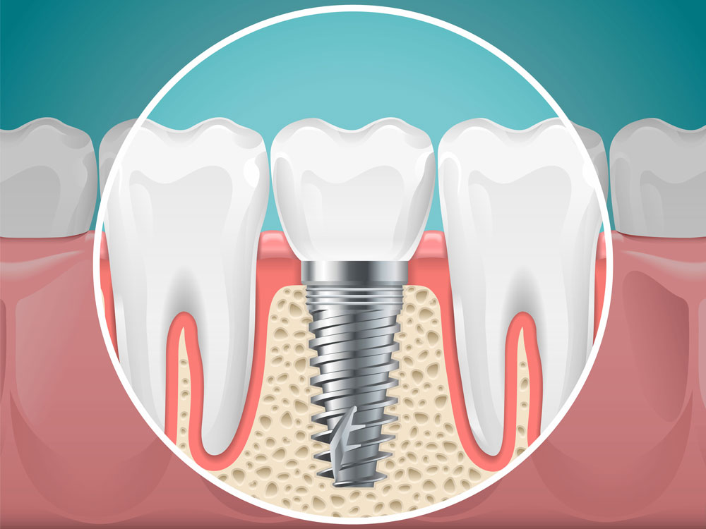 Illustration of a titanium dental implant post supporting a natural-looking crown between two healthy teeth