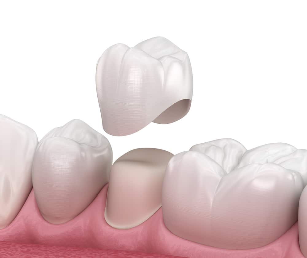 dental crown and fillings