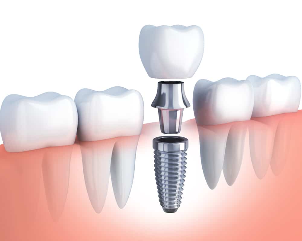 dental implants