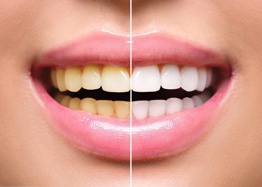 dental teeth whitening