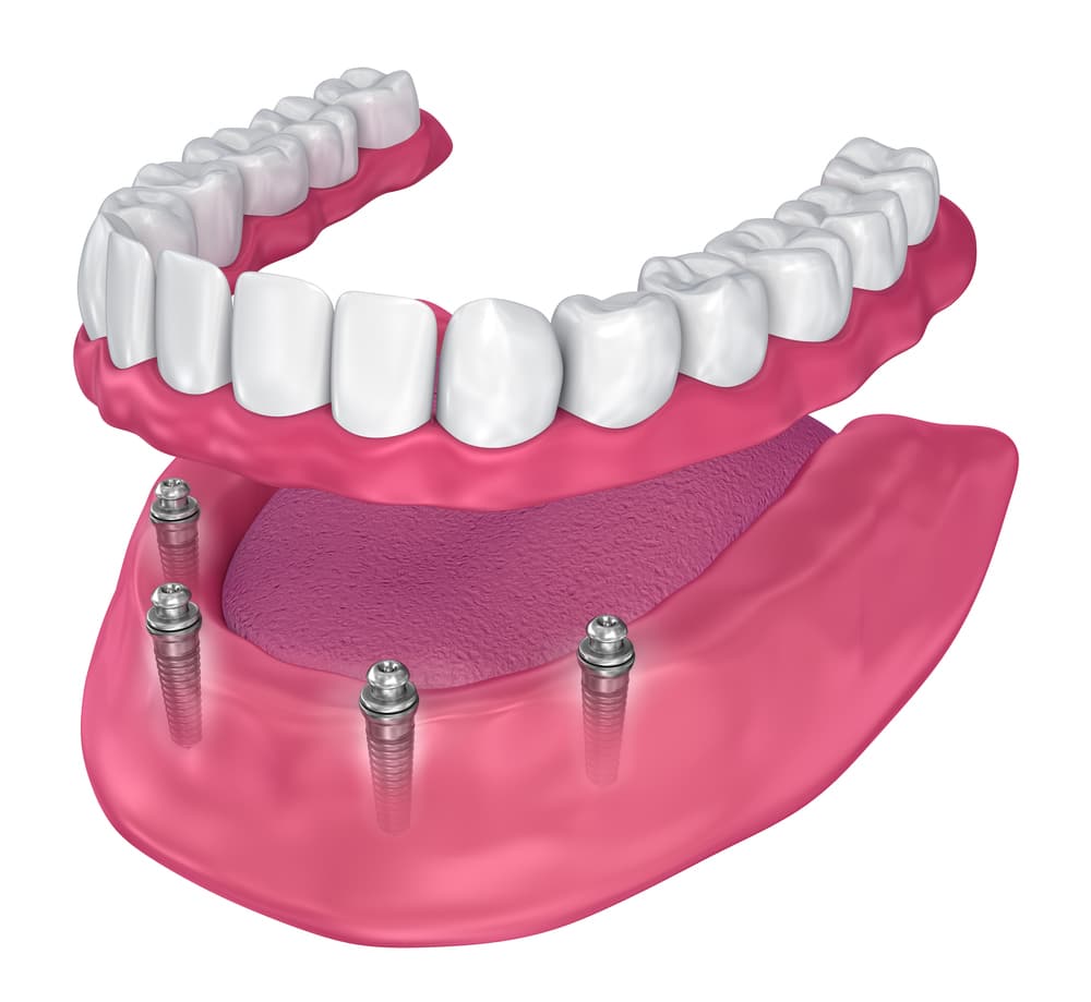 full arch dental implants