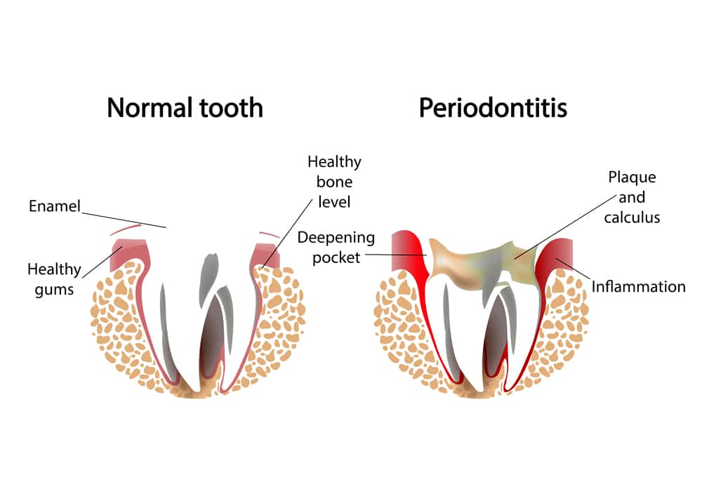 periodontal disease dental services
