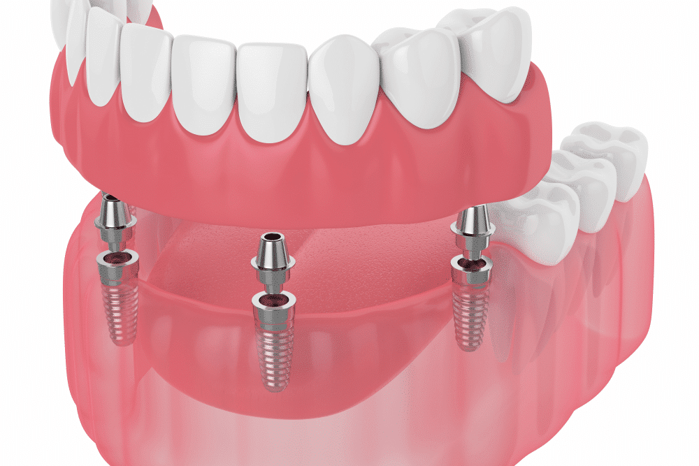 overDentures1 (1)