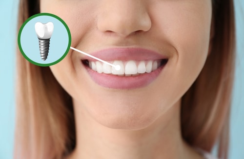 Young,Woman,With,Implanted,Teeth,,Closeup