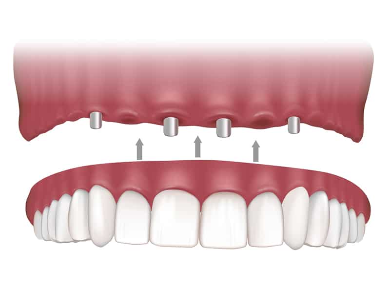 all on 4 dental implant la crescenta